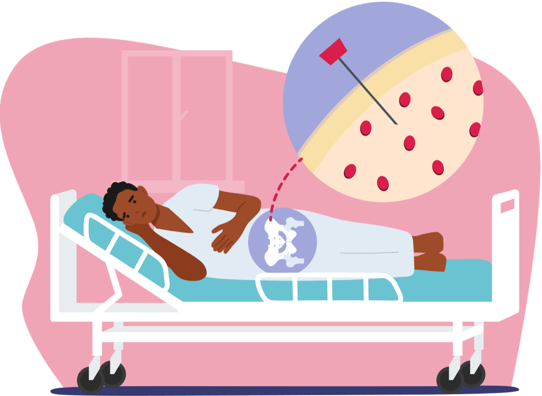 Image of patient lying in hospital bed with zoomed in section where the bone marrow sample is taken from 
